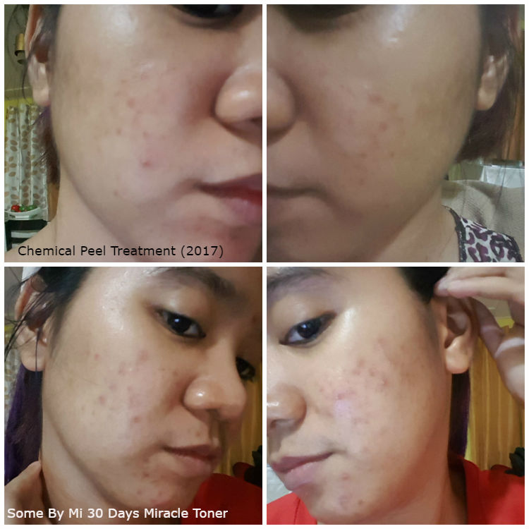 REVIEW] Some By Mi Aha/Bha/Pha 30 Days Miracle Toner (Before and