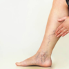 varicose veins