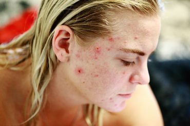 acne skincare