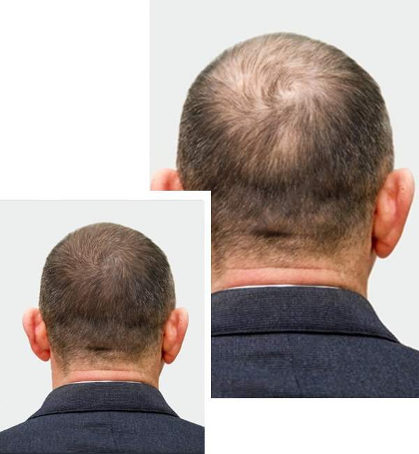 How SMP Compares to Other Hair Loss Solutions?