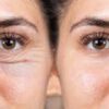 Tips for Achieving Good Results from Wrinkle Filler Treatments in Boston
