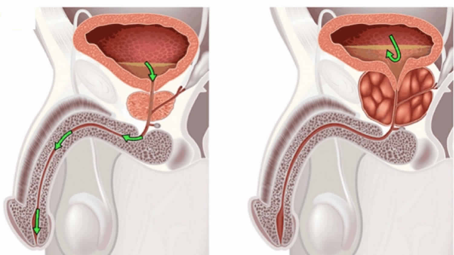 5 Things You Need to Know About Enlarged Prostates