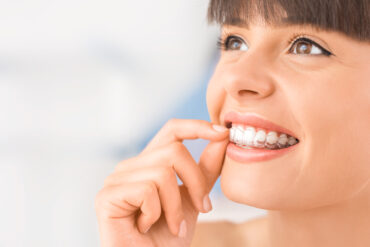 A woman looking up while smiling with clear aligners.
