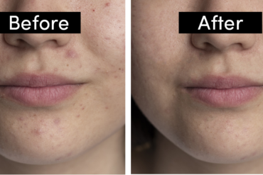 tretinoin before and after